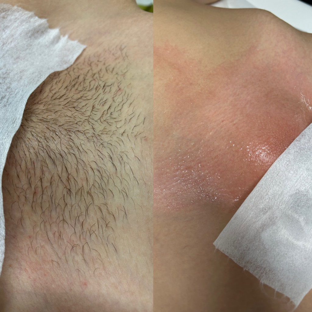 Глубокое бикини