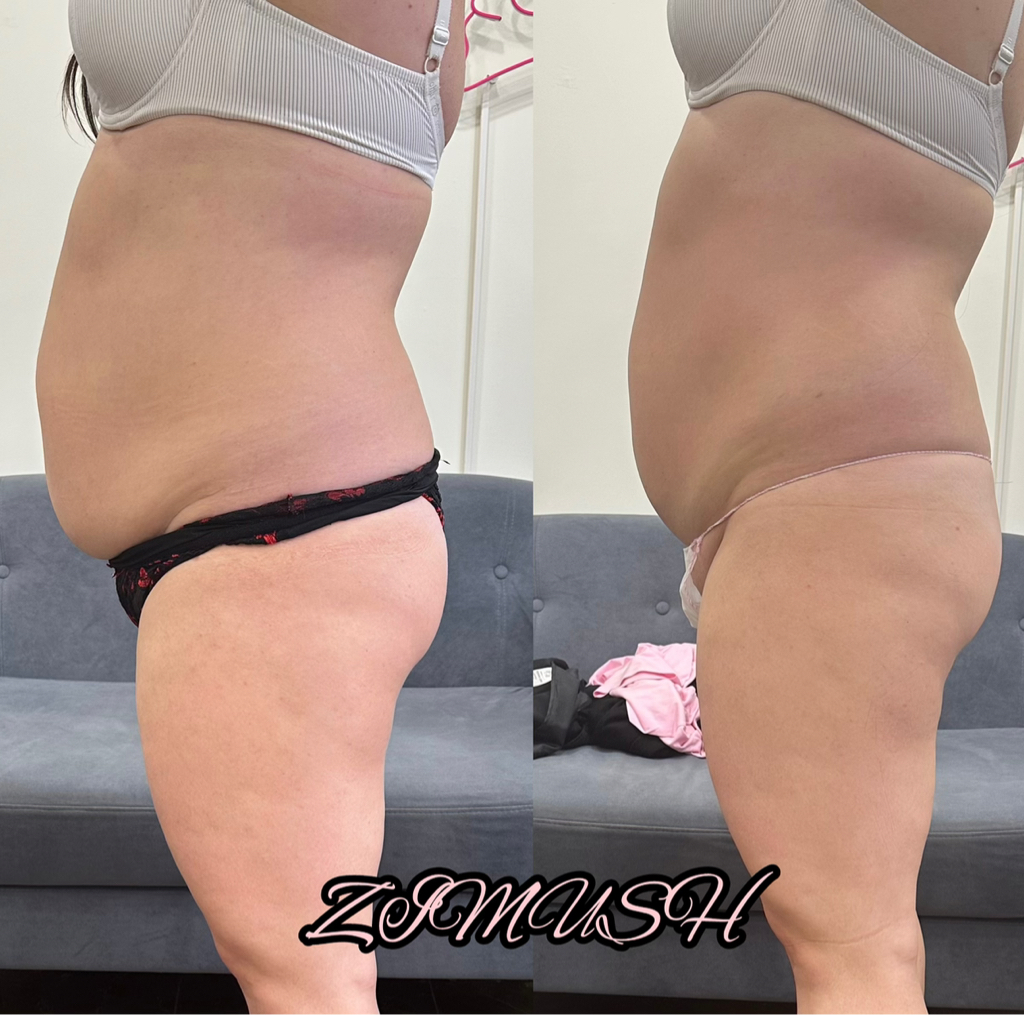 Антицеллюлитный массаж