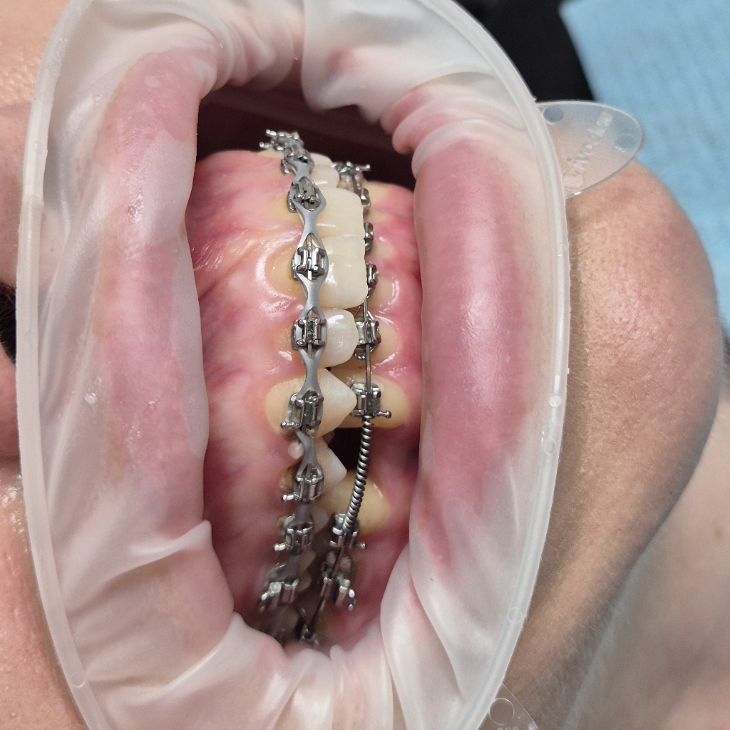 Фиксация брекетов