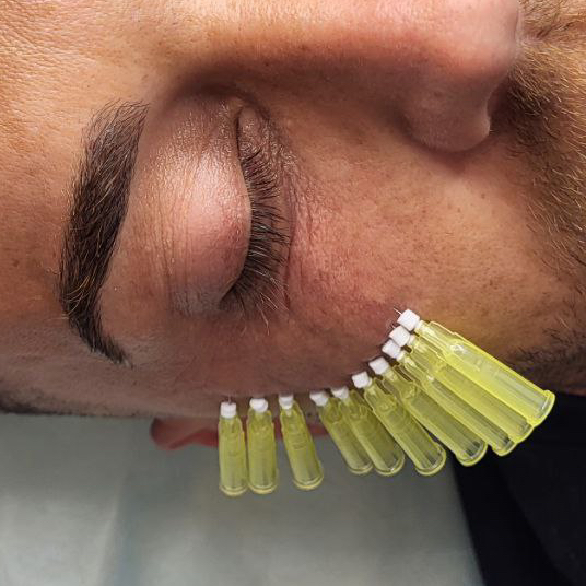 Нитевой лифтинг (COG,Milding, mono)