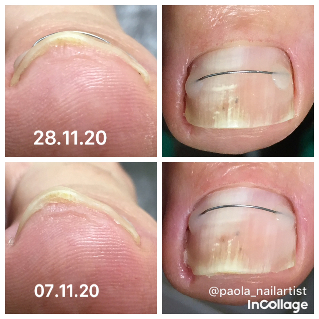 Установка титановой нити 1 большой ноготь