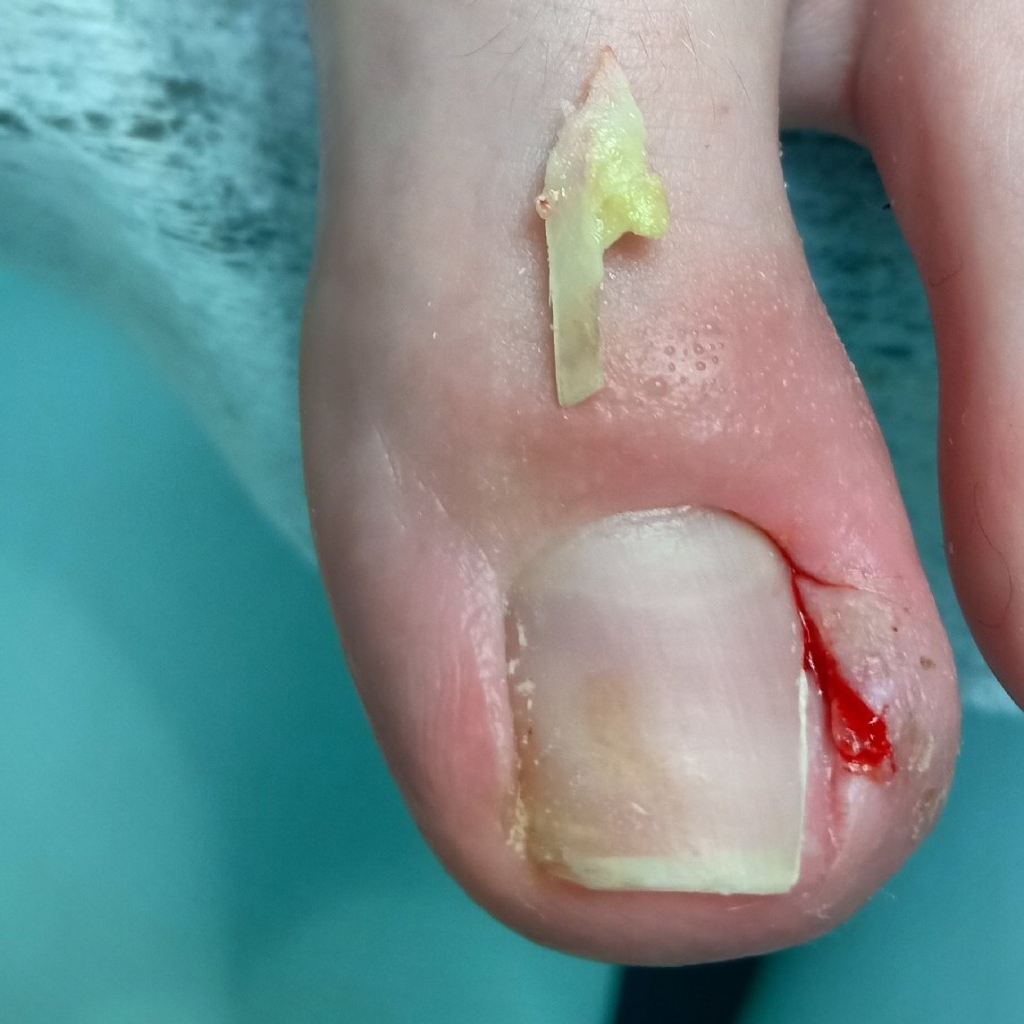 Удаление вросшего ногтя