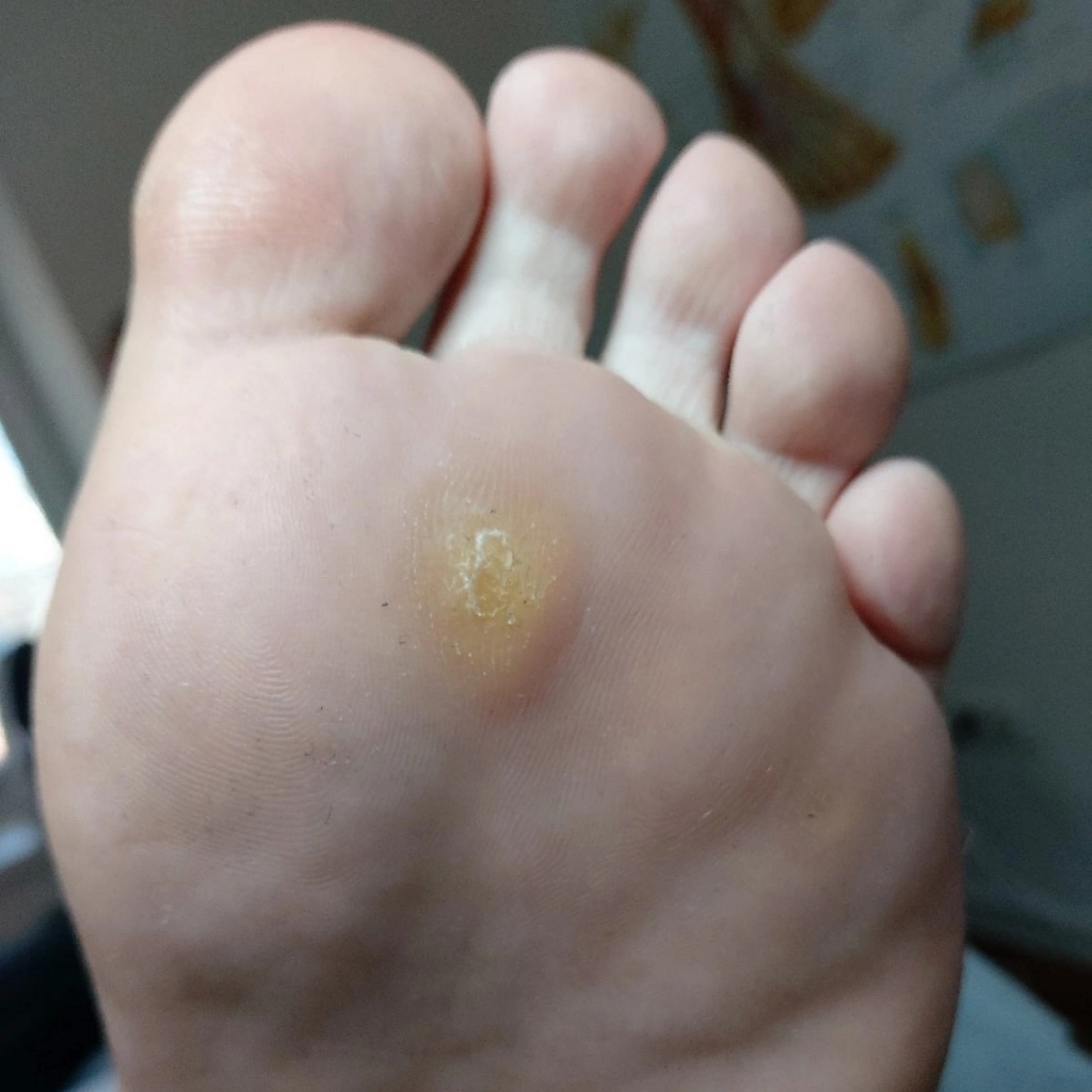 Удаление мозоли