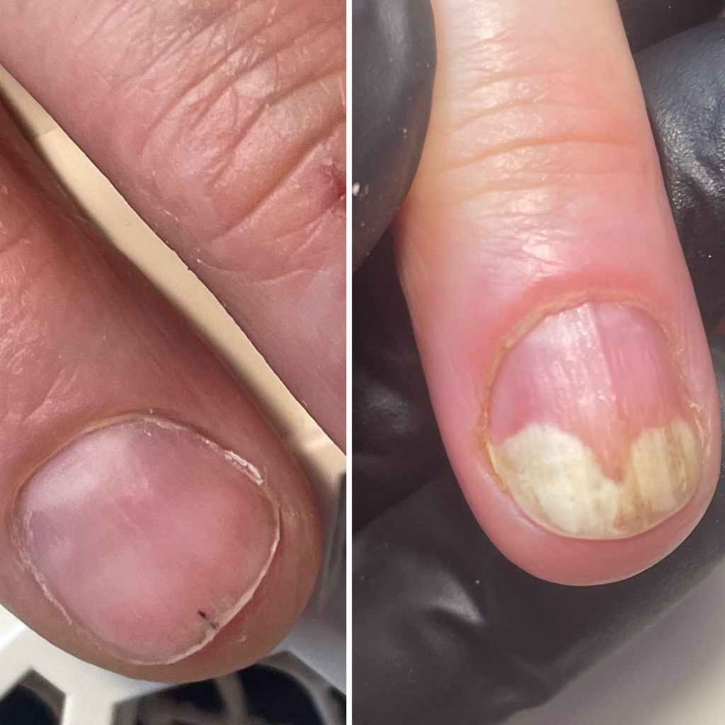 Зачистка ногтя