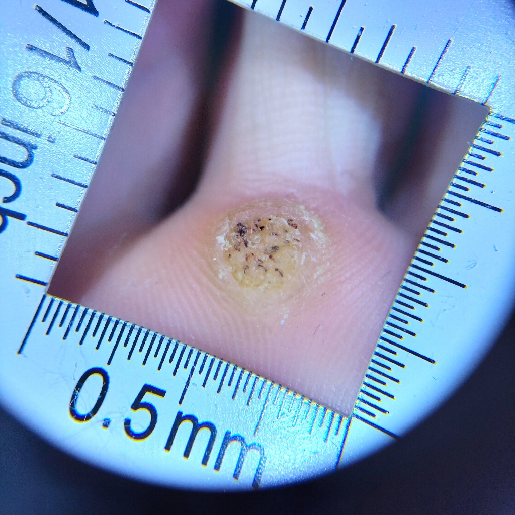 Удаление бородавки