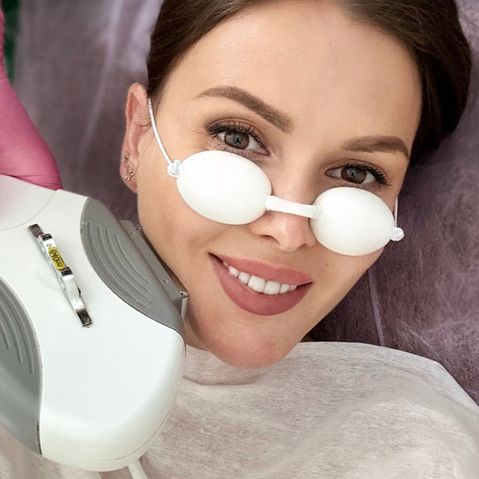 Фотоомоложение + Лечение акне+Устранение купероза