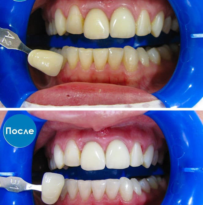 Отбеливание зубов без укрепления