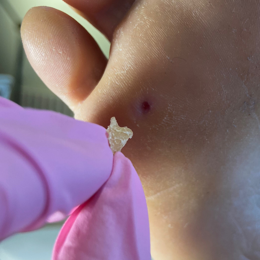 Обработка стержневой мозоли