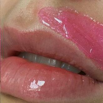 Удаление нежелательных волос