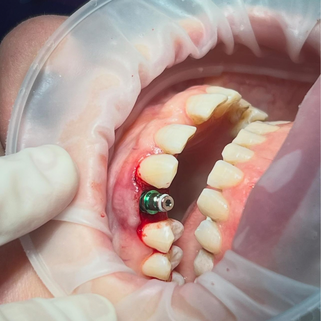 установка импланта Osstem (Корея)