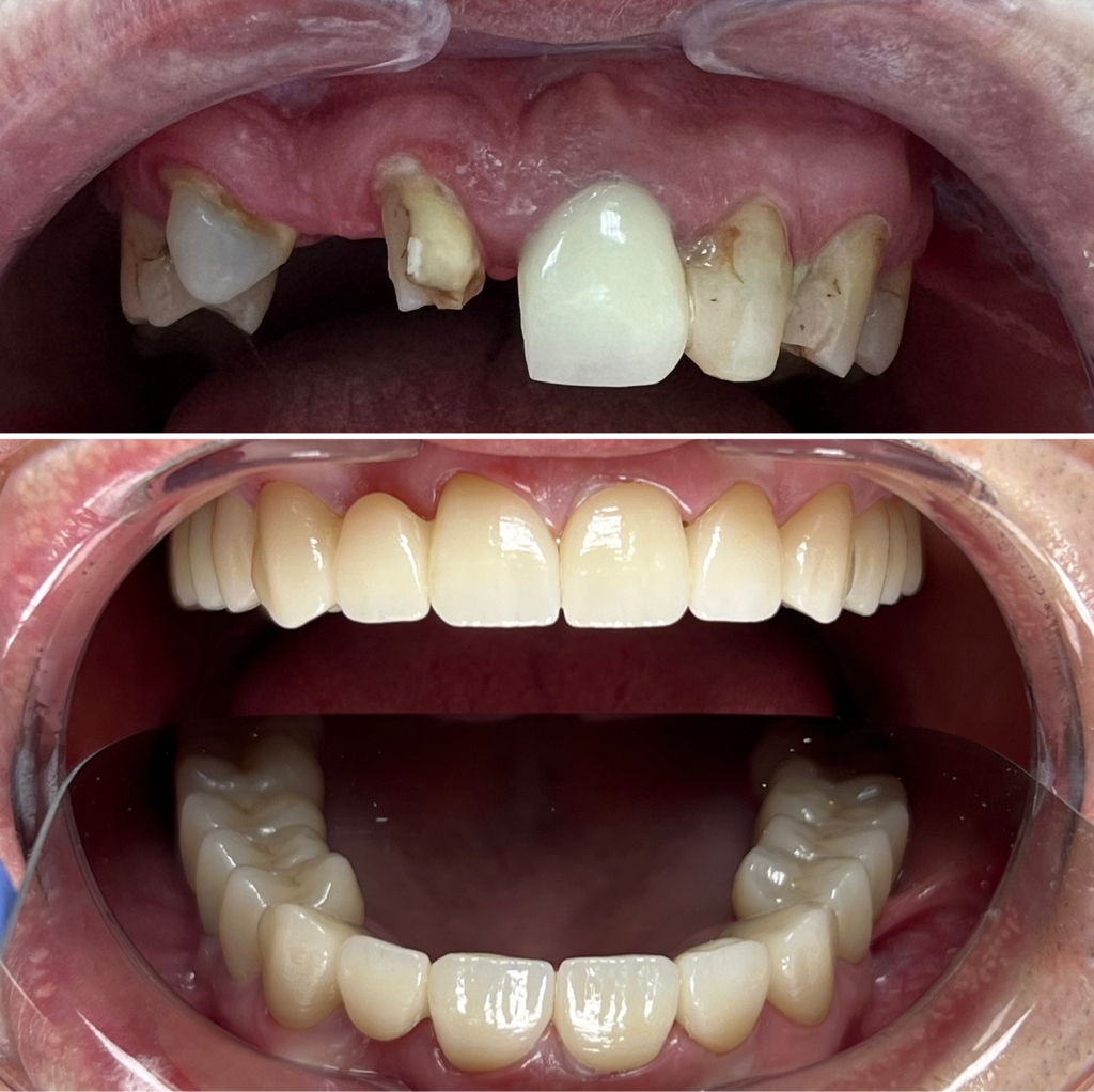 Керамическая безметалловая коронка на оксиде циркона