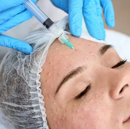 Мезотерапия