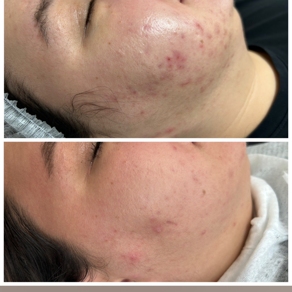 Комбинированная чистка лица