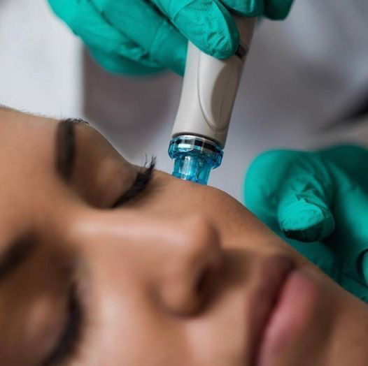 Фракционная мезотерапия  (Dermapen)