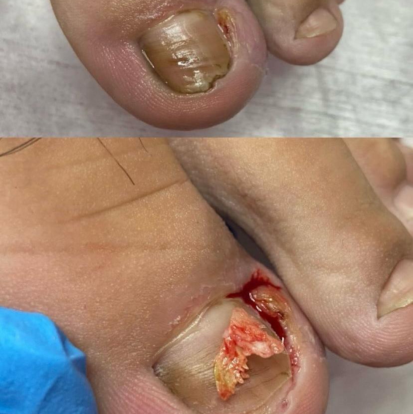 Вросший ноготь