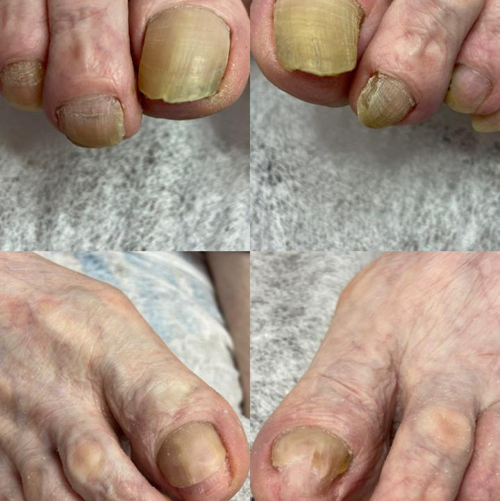 Зачистка проблемного ногтя (онихомикоз, онихогрифоз)