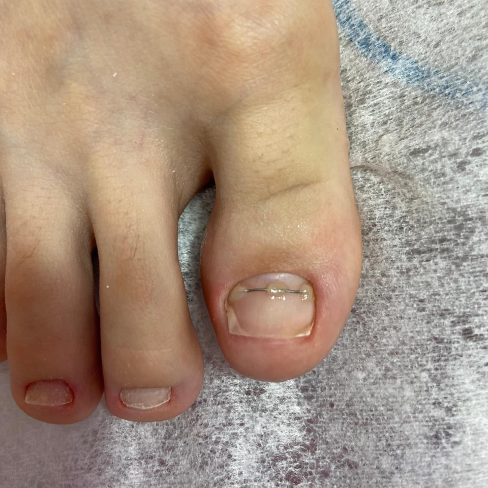 Установка КС на 1 ноготь