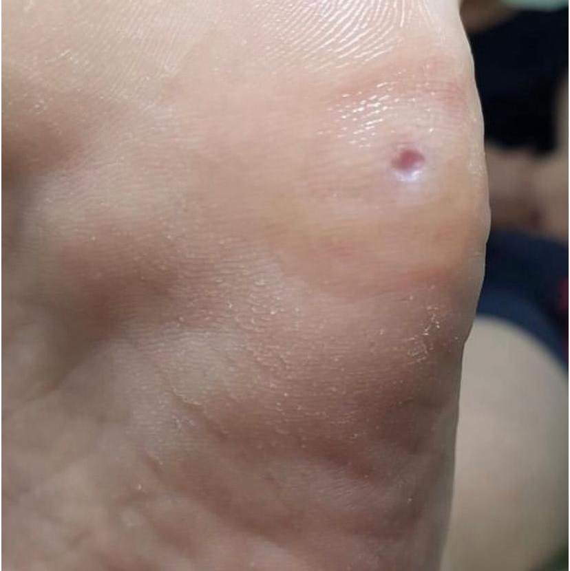 Стержневая мозоль / натоптыши