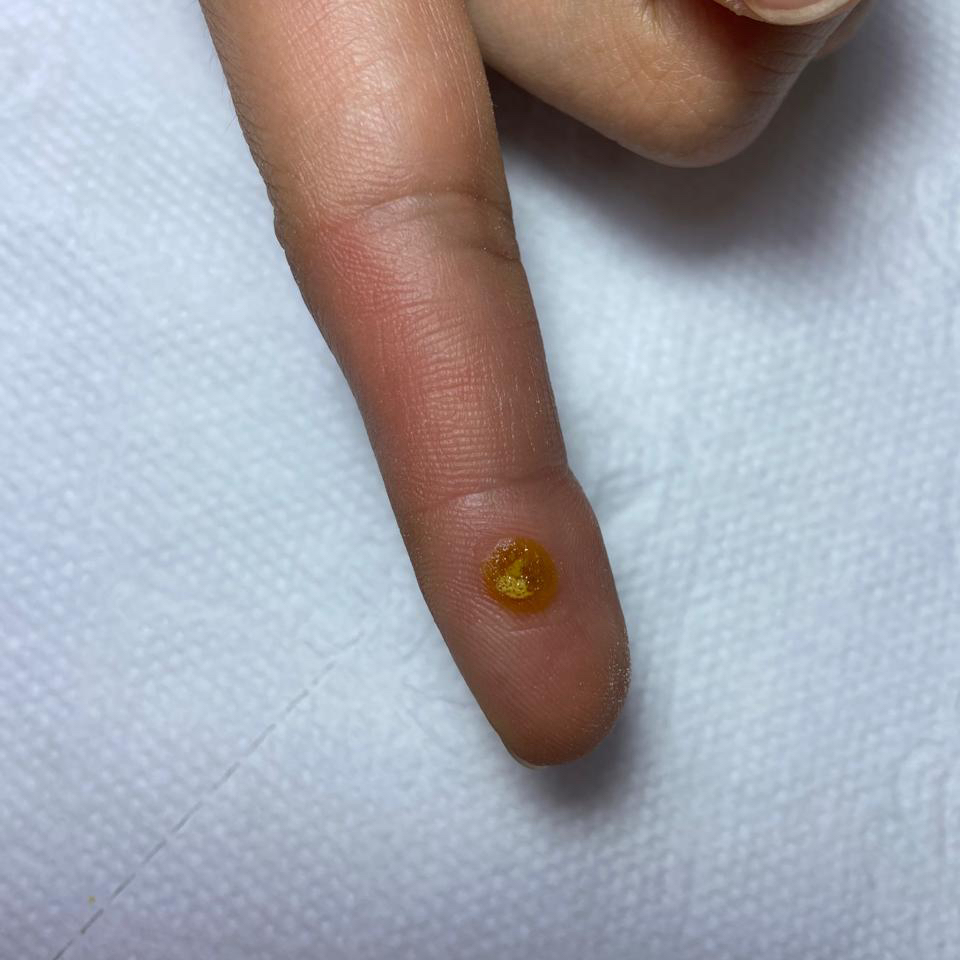 Бородавка ( обработка и прижигание)