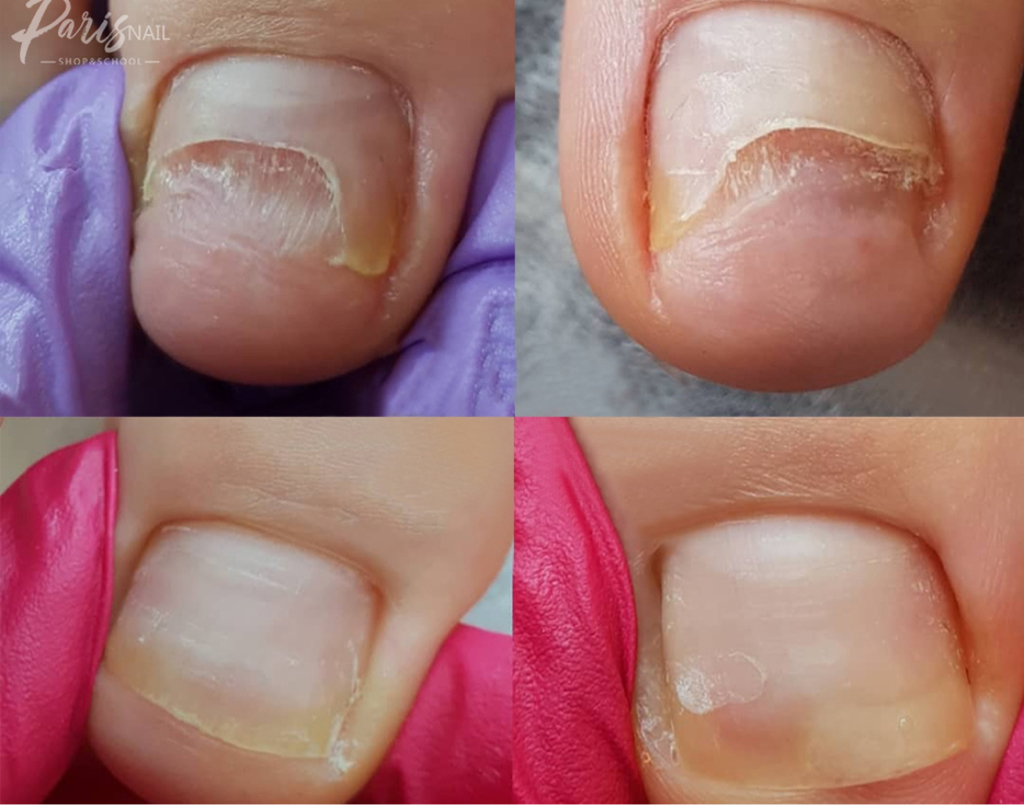 Зачистка онихолизиса