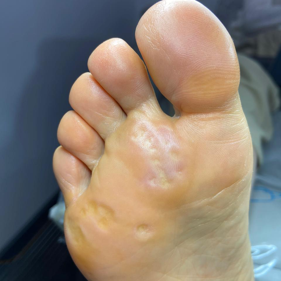 Обработка проблемных стоп