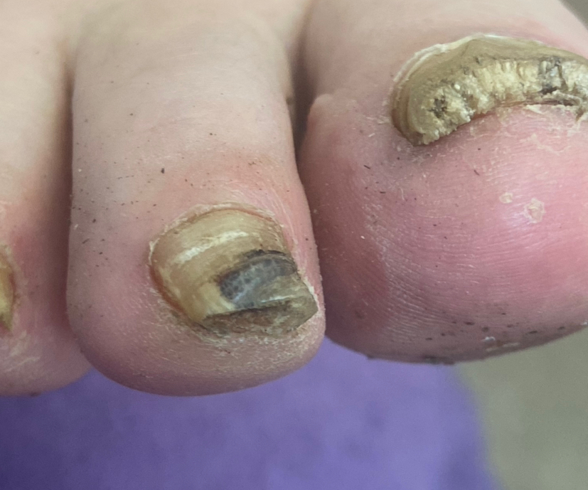 Обработка грибка на ногтях