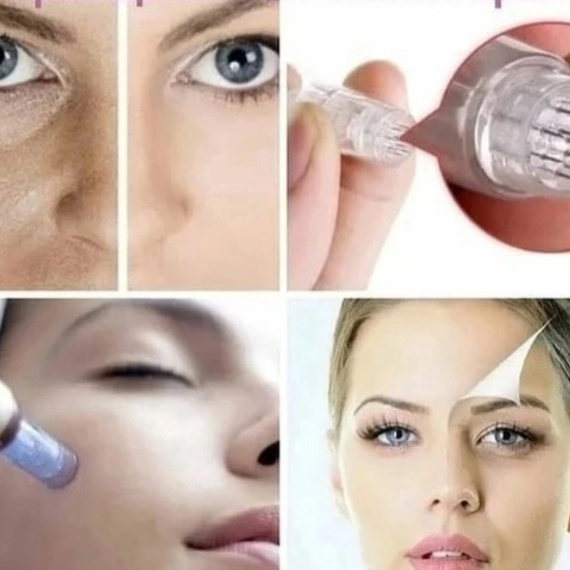 Фракционная Мезотерапия