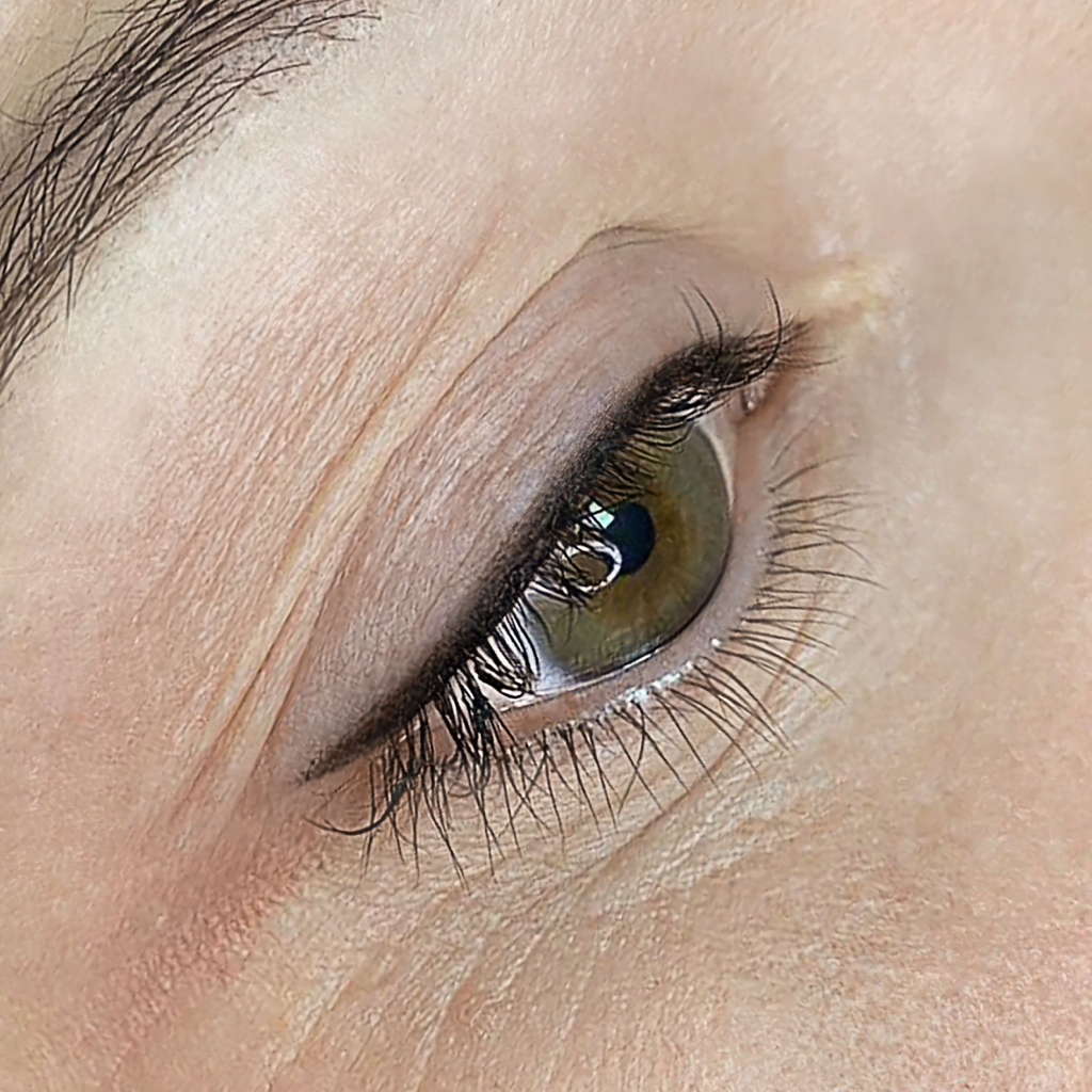 Коррекция межреснички