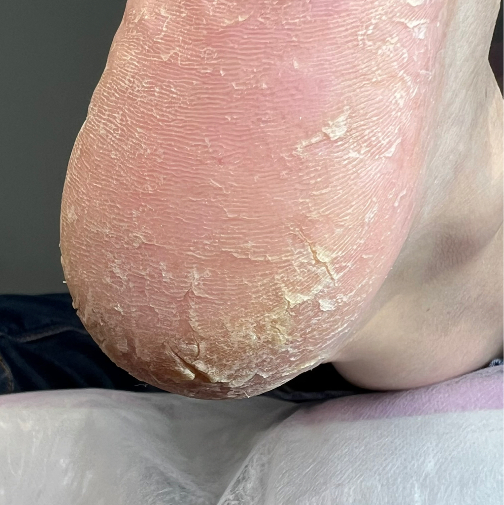 Подологический педикюр