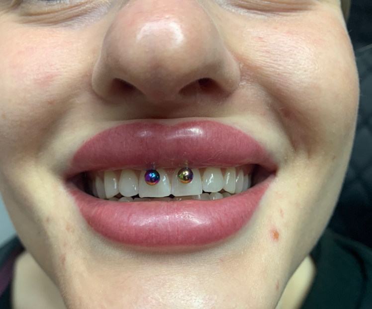 Пирсинг смайл