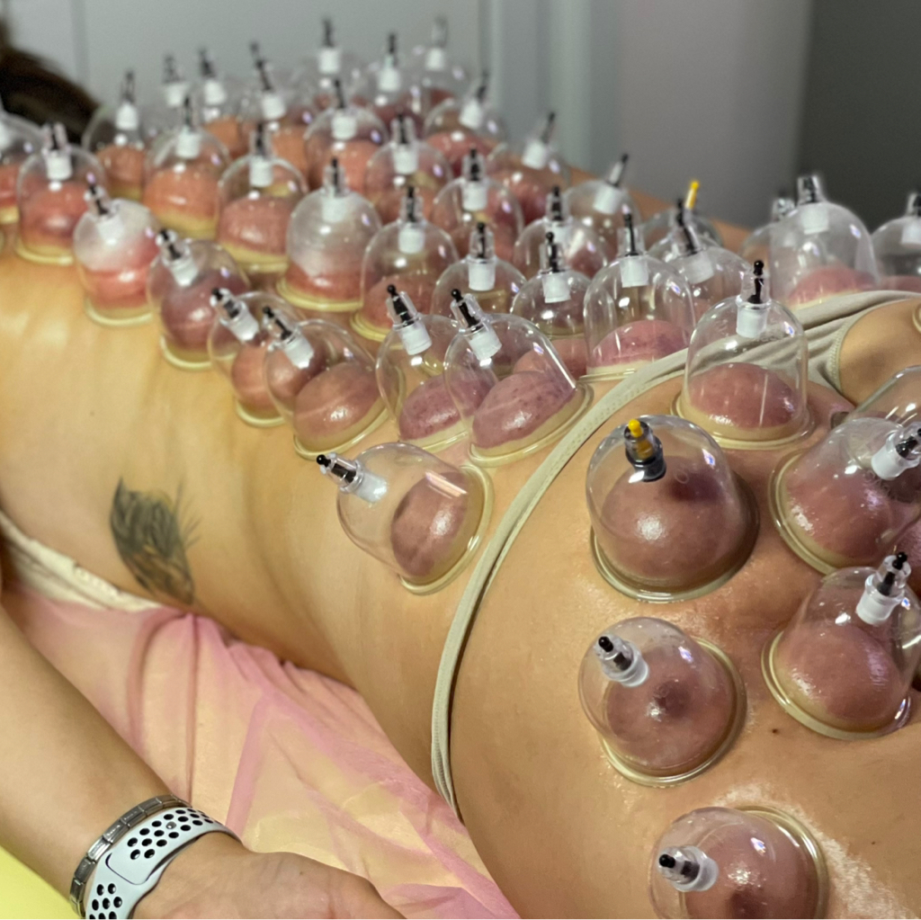 Постановка банок - все тело