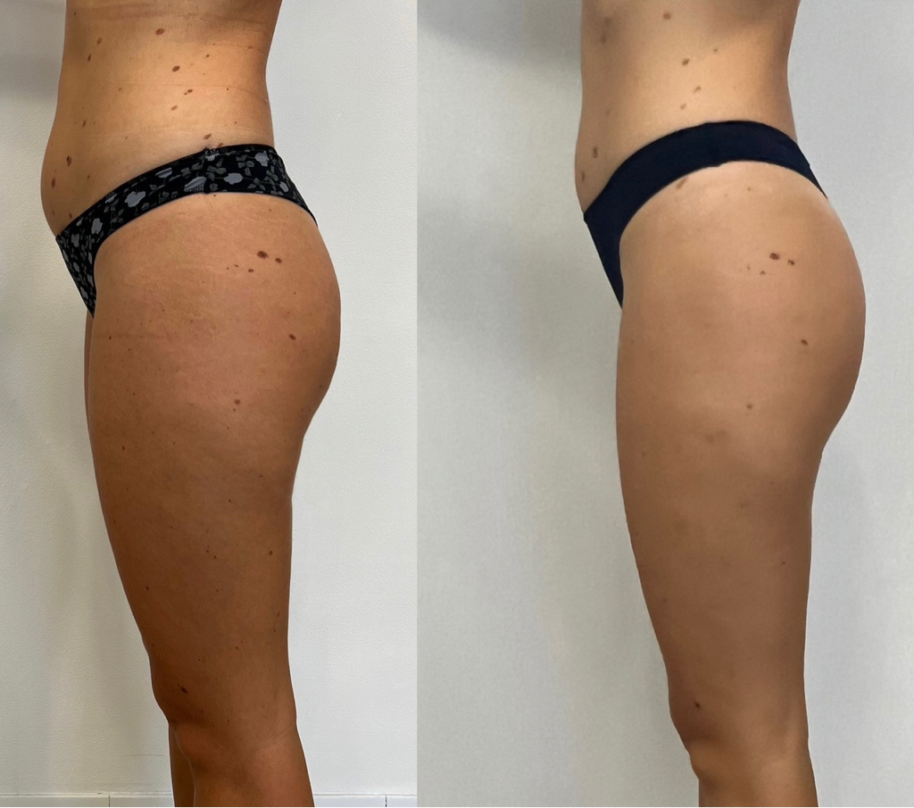 Антицеллюлитный/Лимфодренажный массаж