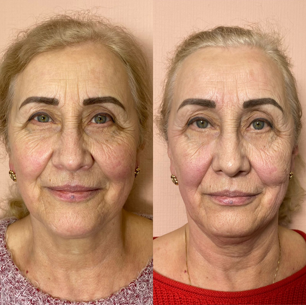 Массаж лица Коруги