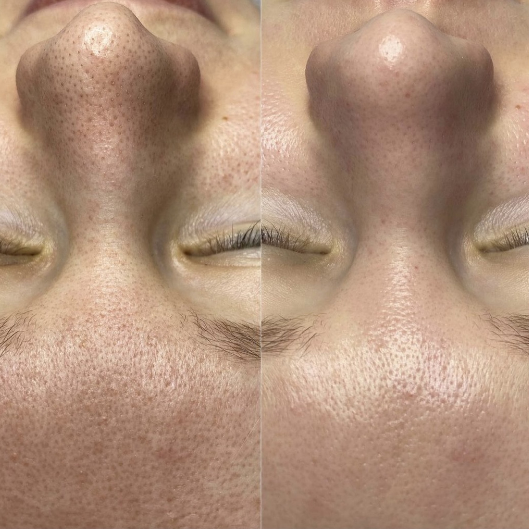 ČIŠĆENJE LICA ГИГИЕНИЧЕСКАЯ ЧИСТКА ЛИЦА