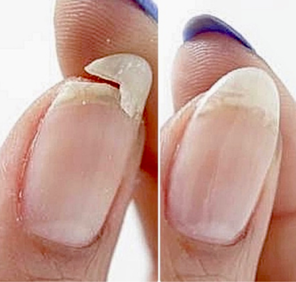 Nail repair