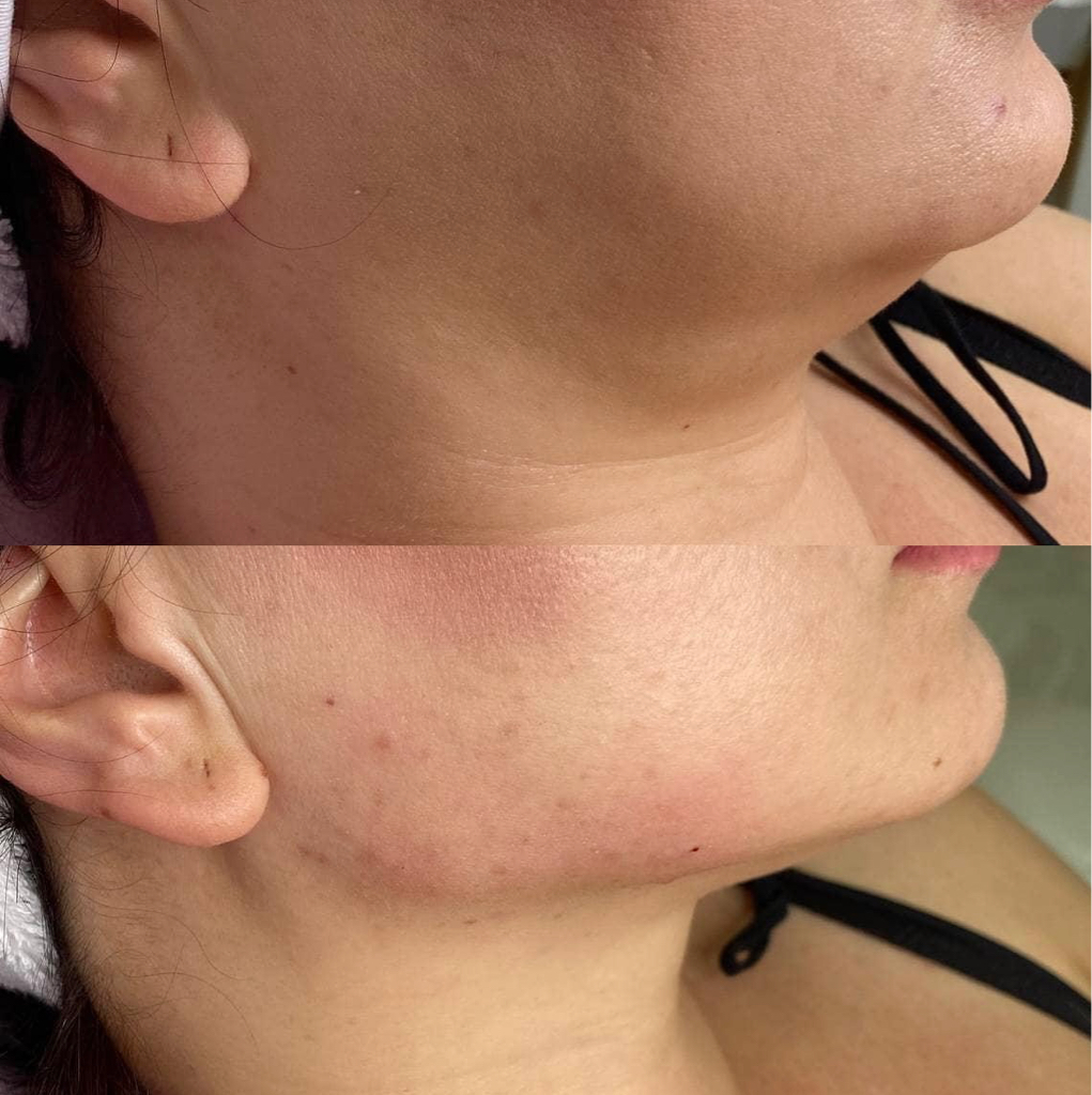 Липолитика