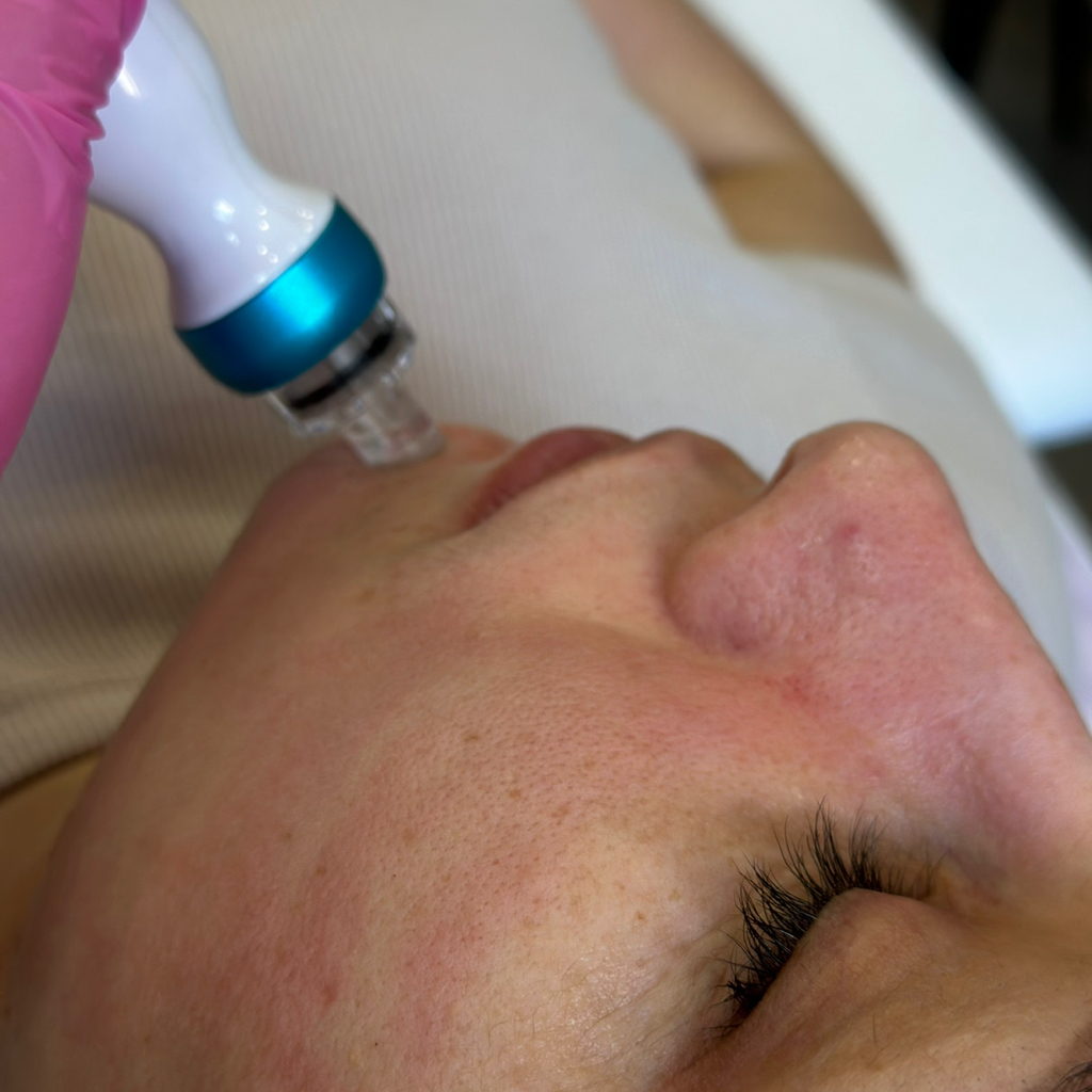 Аквапилинг HydraFacial