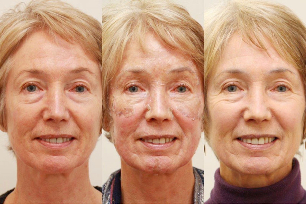 ЛИФТИНГ+⬇️МОРЩИН Пилинг DUO лицо
+набор кремов