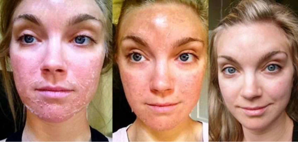 ЛИФТИНГ+⬇️МОРЩИН Пилинг ТСА лицо+шея
+набор кремов