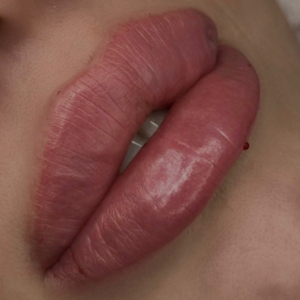 Аугментация губ