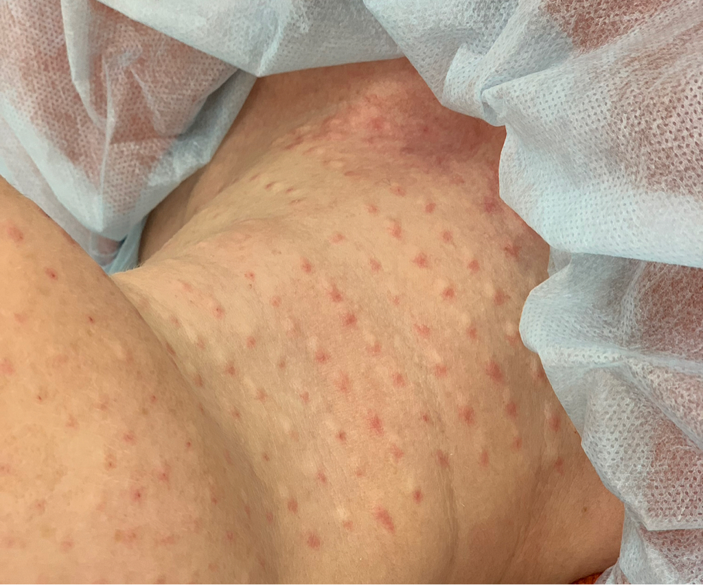 Биоревитализация