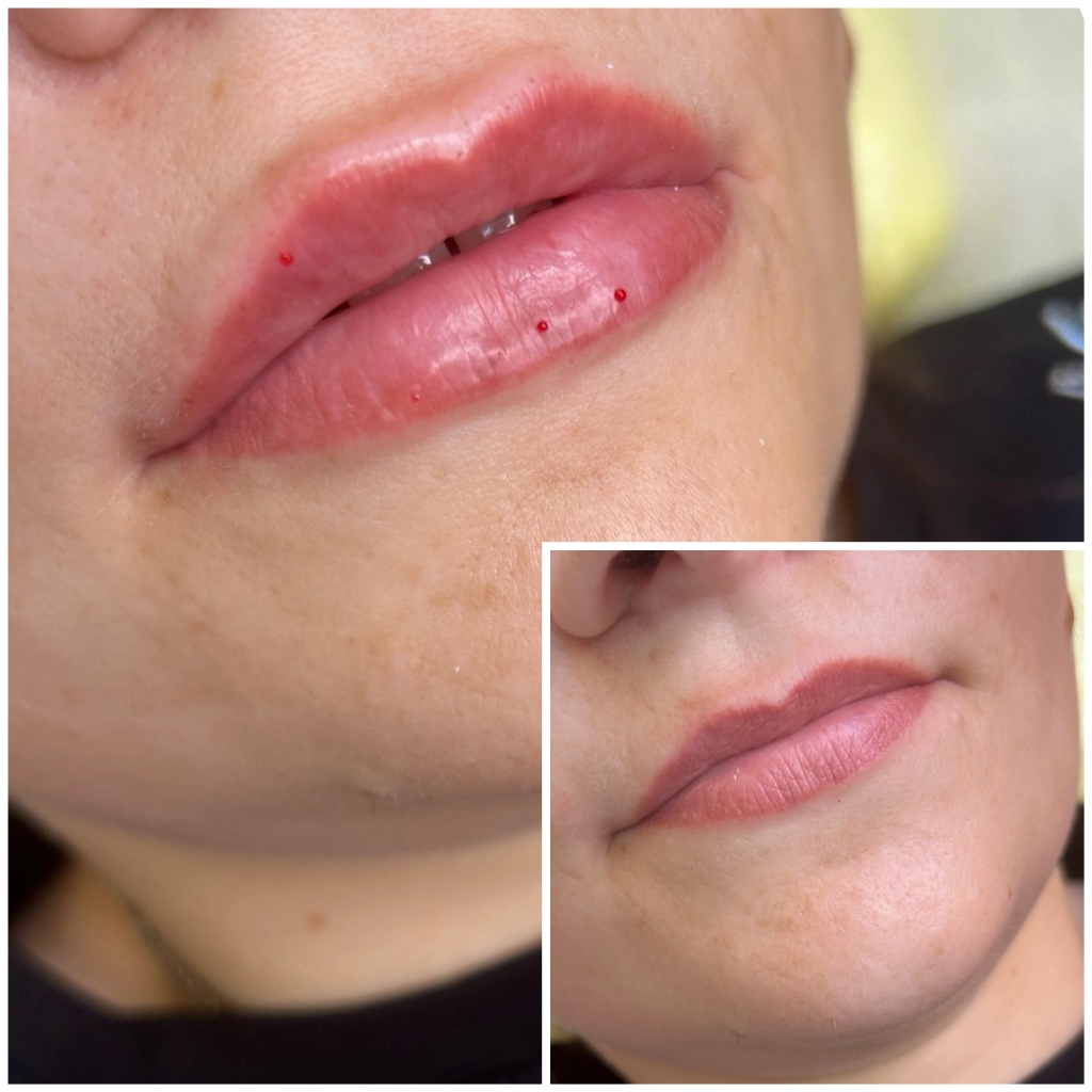 Увеличение губ
ЦЕНА ЗАВИСИТ ОТ ПРЕПАРАТА