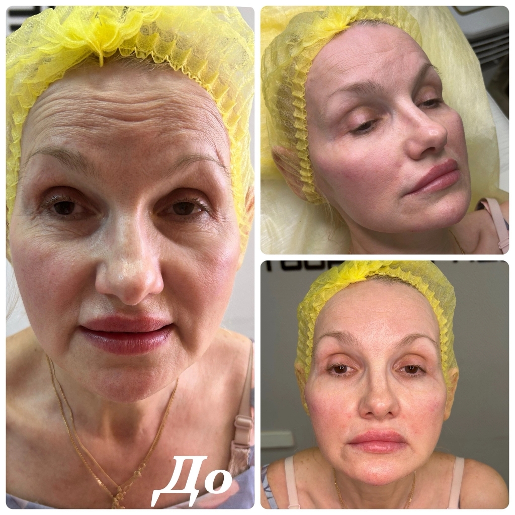 Заполнение носокубки
Цена зависит от препарата