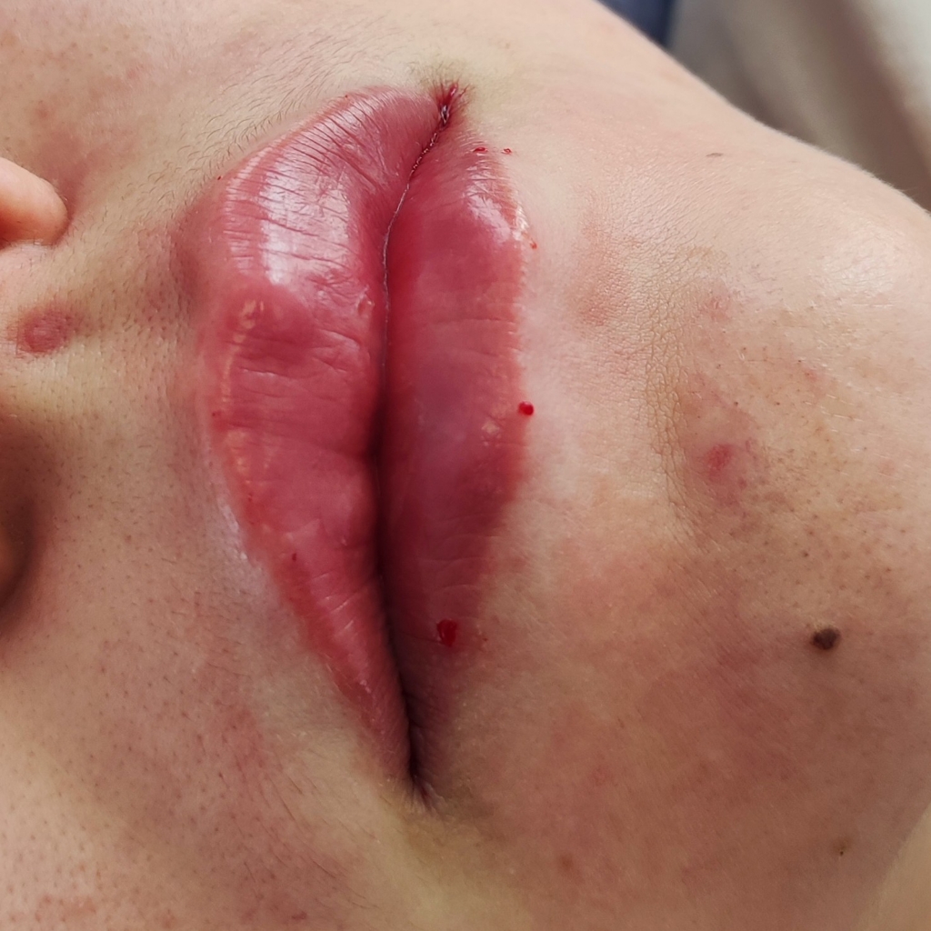 биоревитализация губ