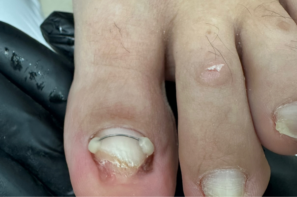 Титановая нить