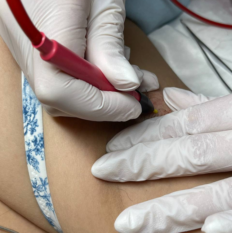 Электроэпиляция 1  час