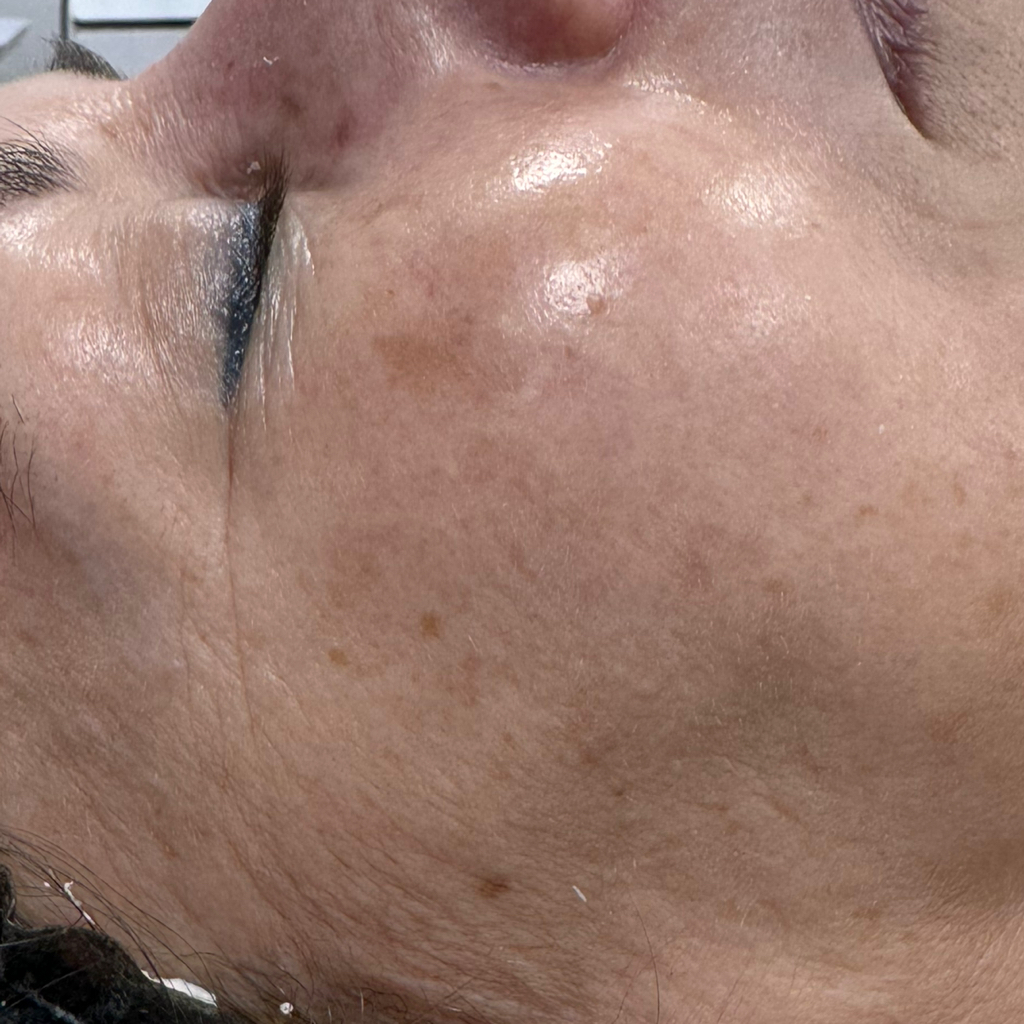 Неинвазивная биоревитализация