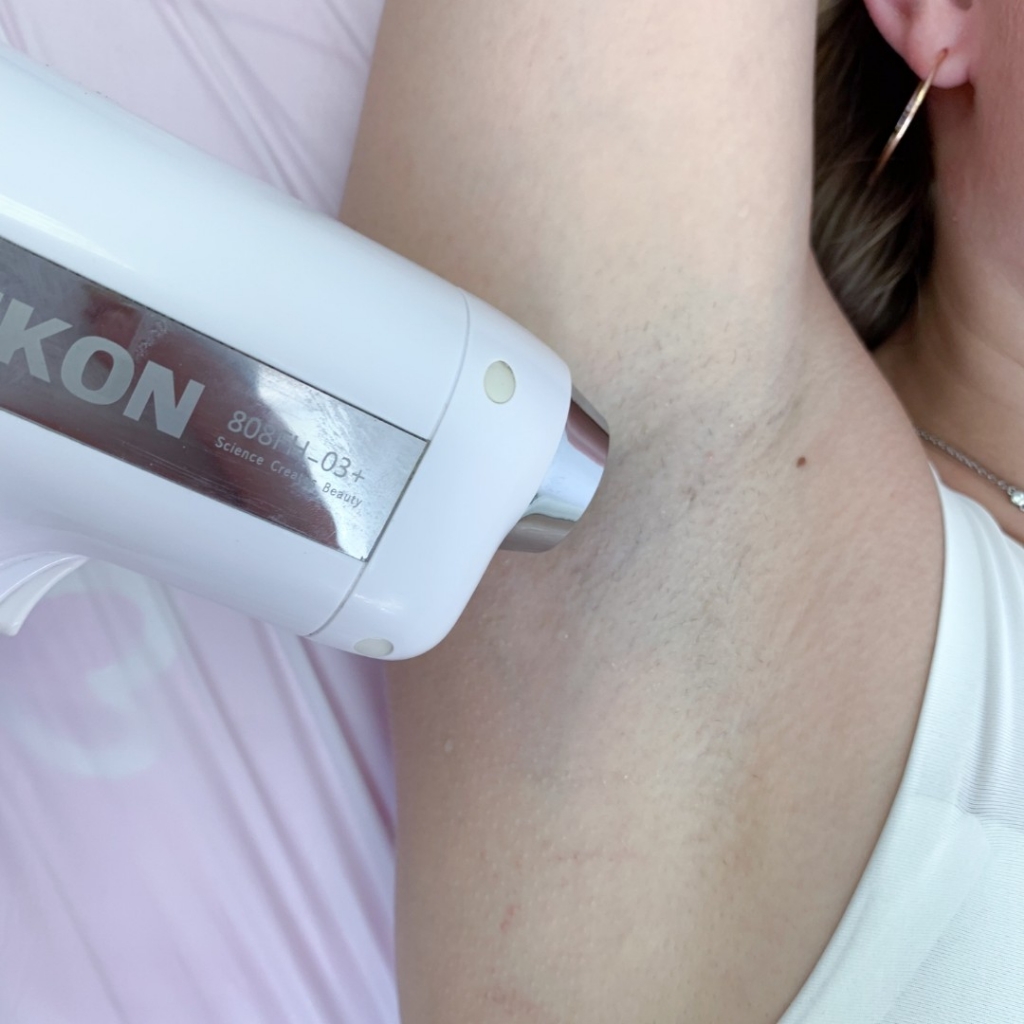 Лазер: подмышечные впадины