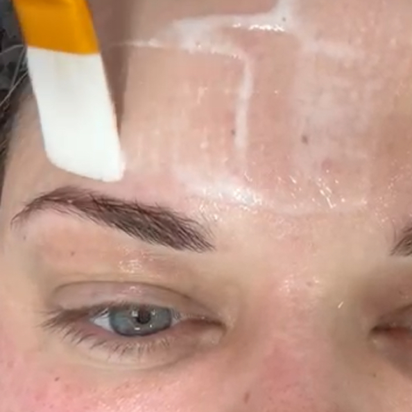 Карбокситерапия