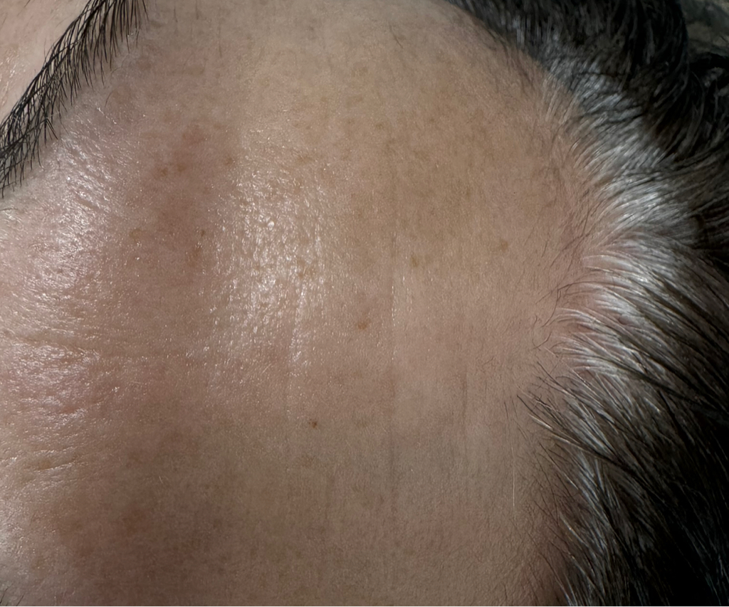 Атравматическая пептидная гликолево - лактобионовая пилинг-чистка